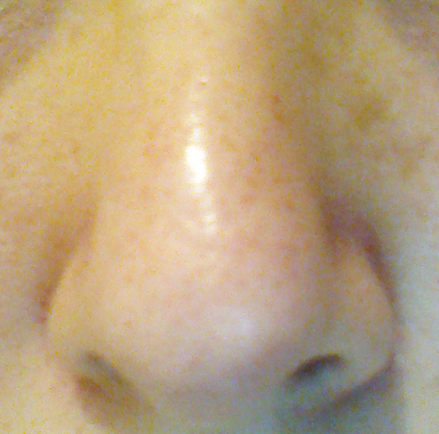 Results after two months' use of COSRX BHA Blackhead Power Liquid