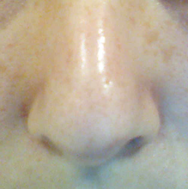 Nose pores cleared with BHA use